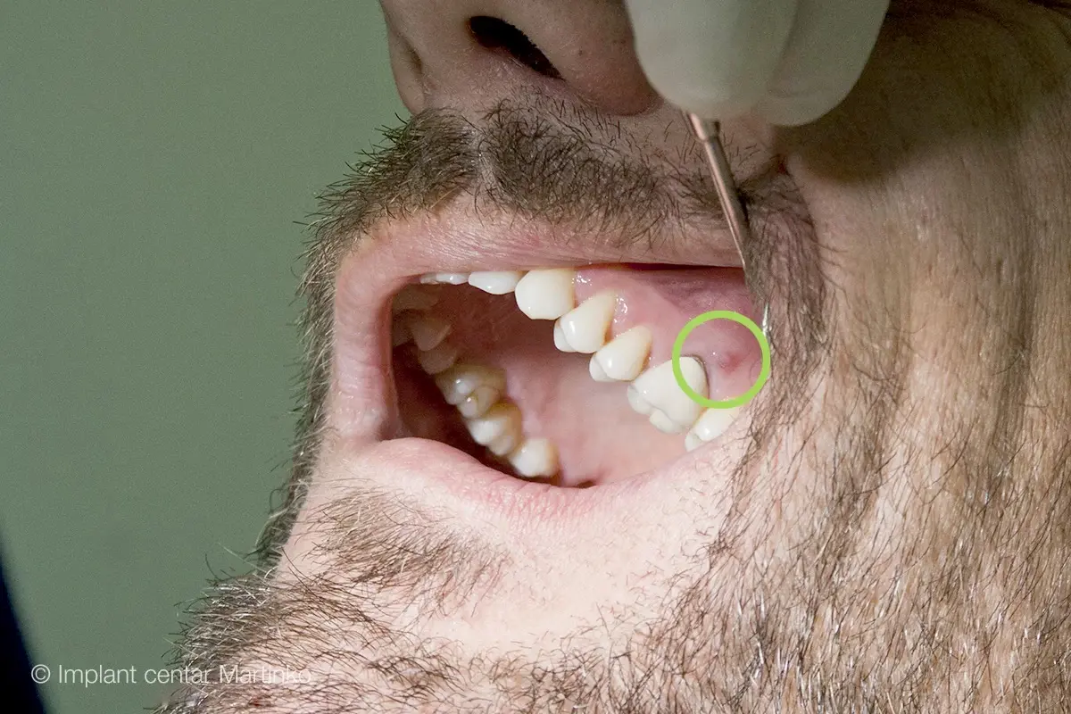 Che cos’è un granuloma?