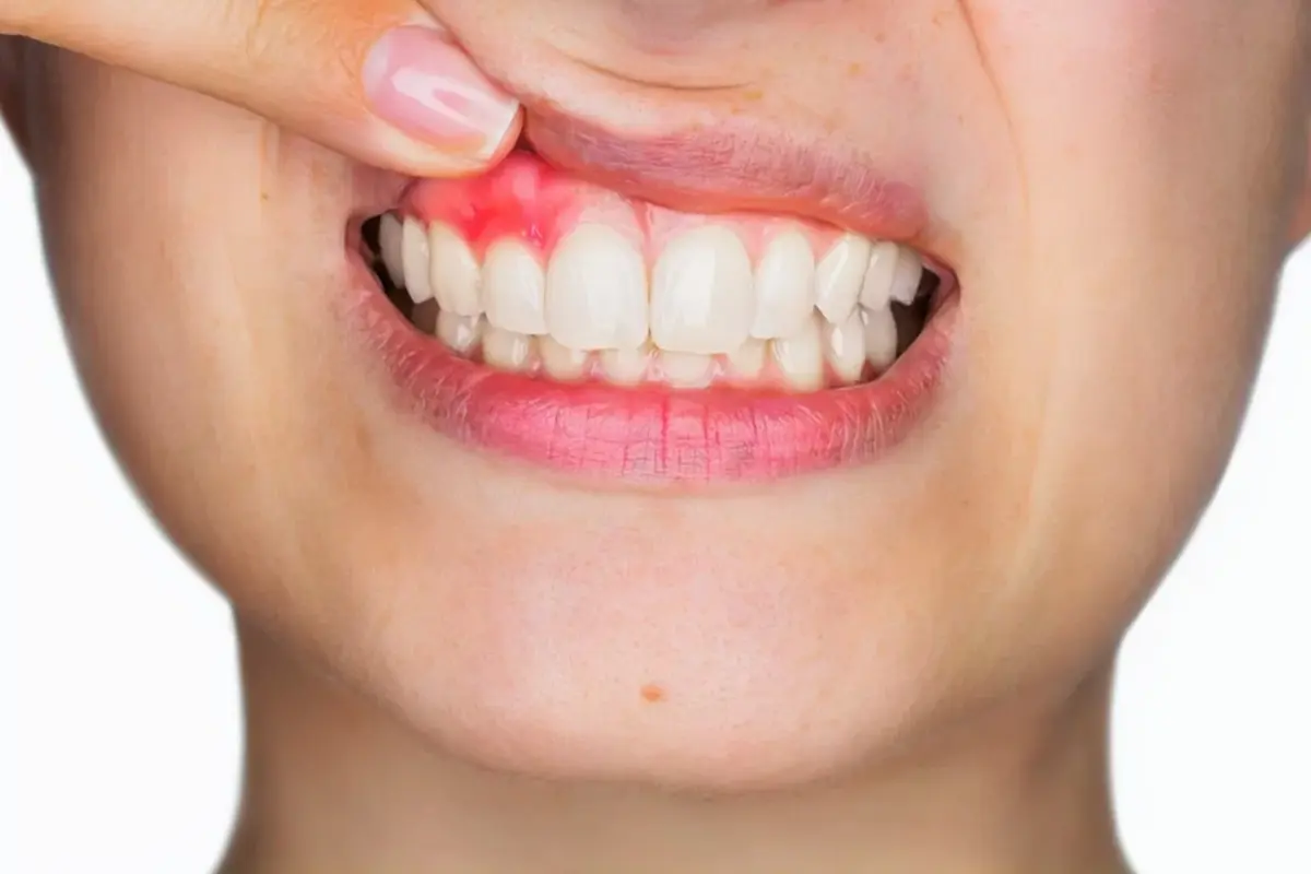Parodontite e implantologia dentale