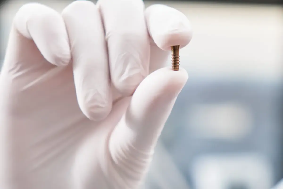 Rispondiamo alle domande più frequenti su impianti dentali