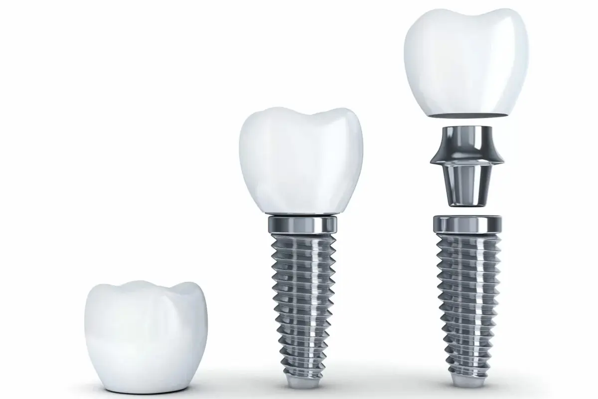 Quali sono i migliori impianti dentali – guida completa