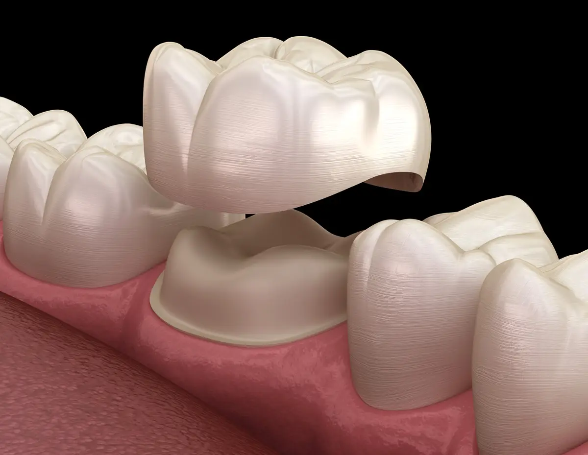 Corona su dente naturale