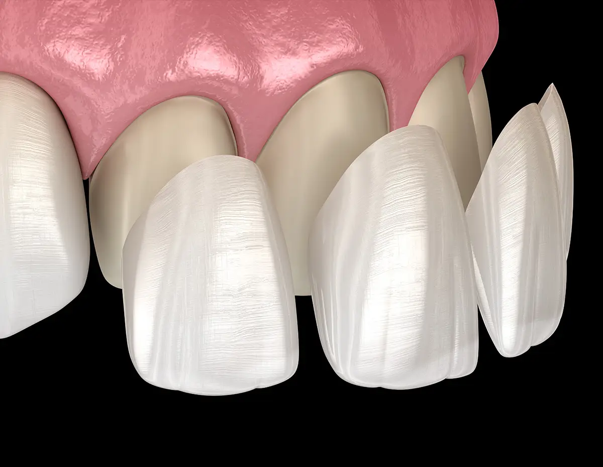 Faccette dentali