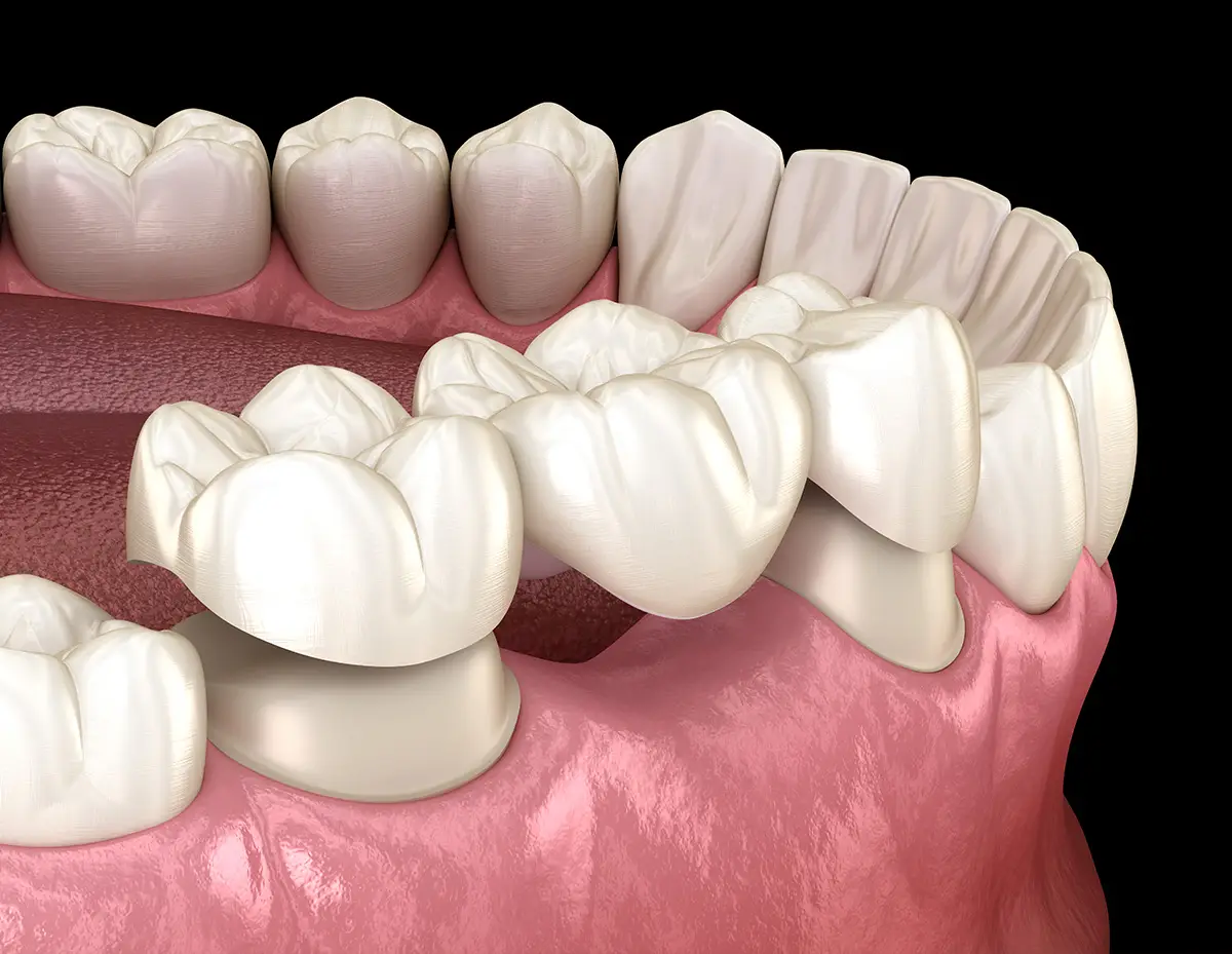 Ponte sui denti naturali