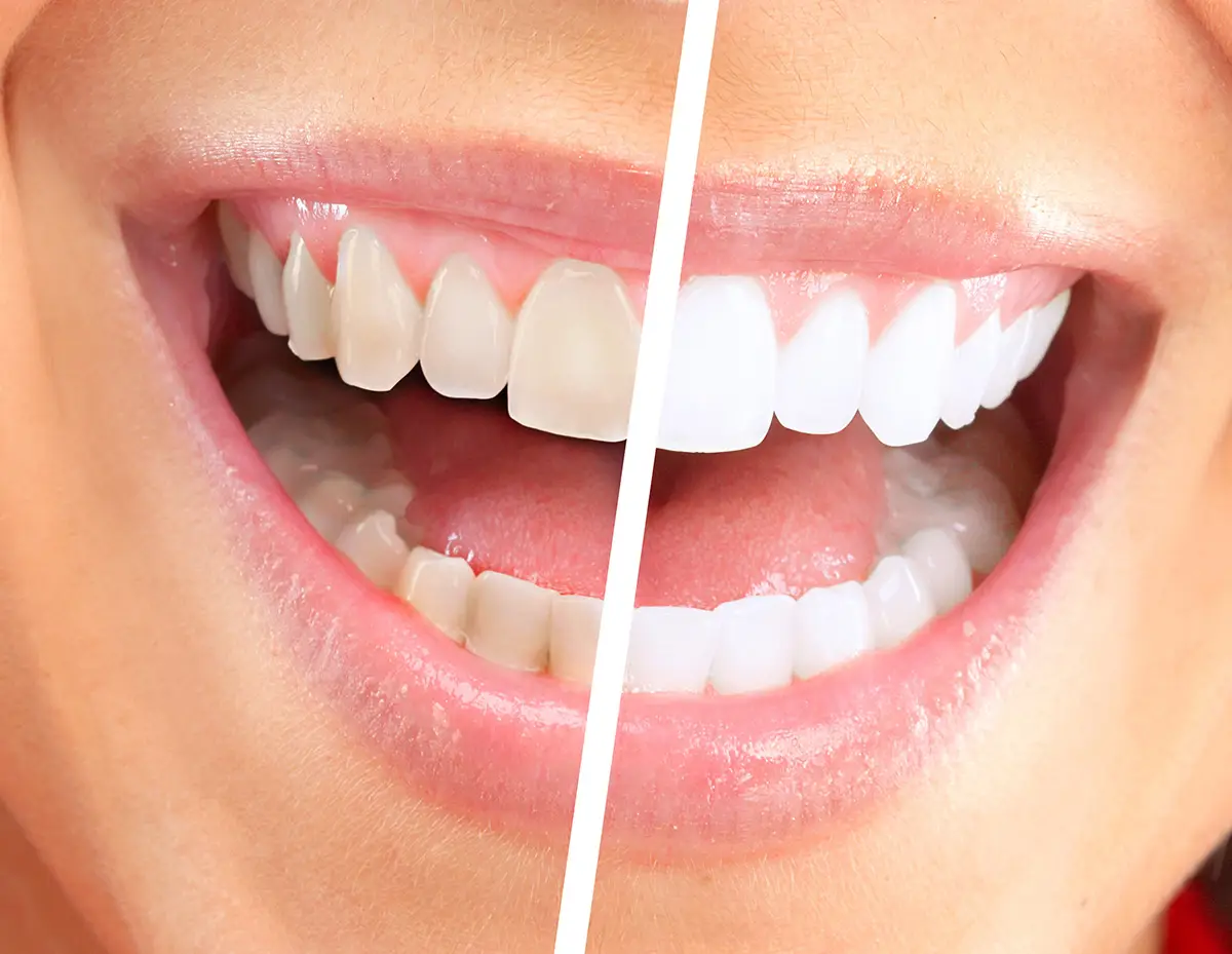 Sbiancamento dei denti